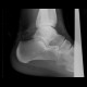 Atypical fracture of calcaneus, fracture: X-ray - Plain radiograph